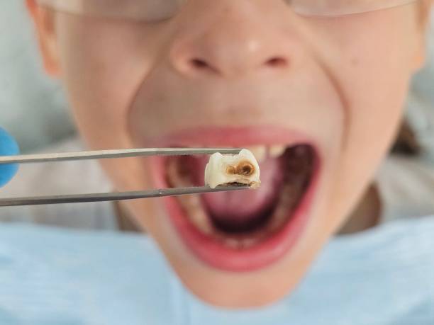 Best Emergency Tooth Extraction in Lawrenceburg, KY